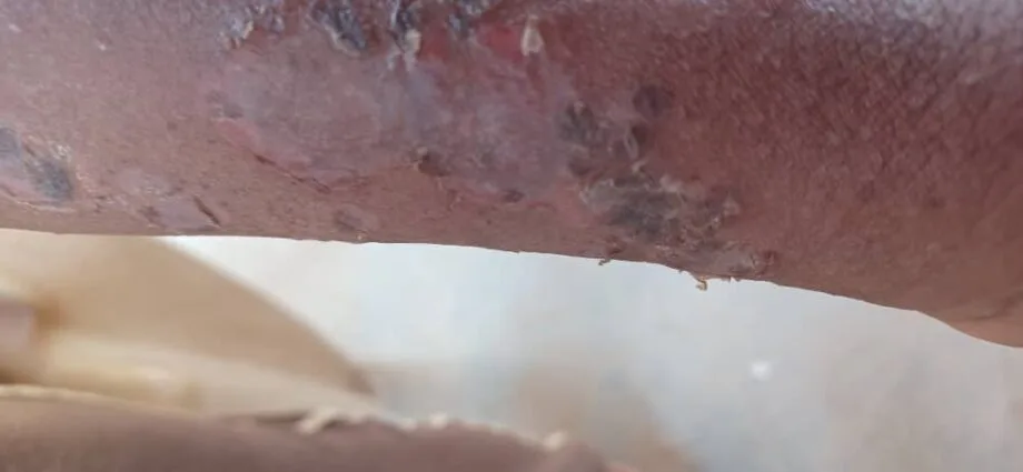 مرض أبو الصميق المنتشر في السودان