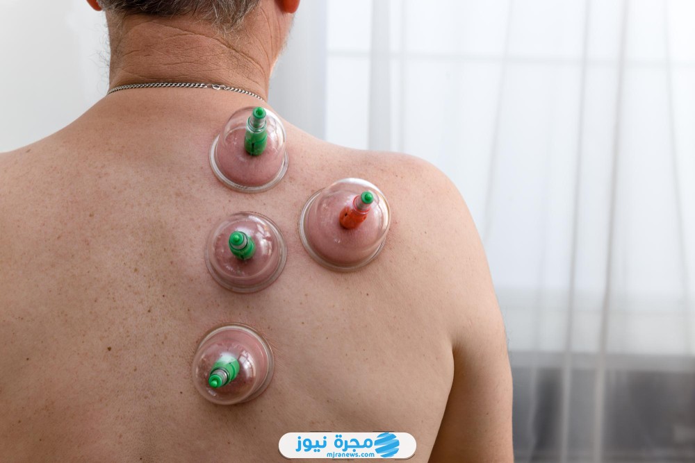 أفضل أيام الحجامة لشهر فبراير شباط 2025